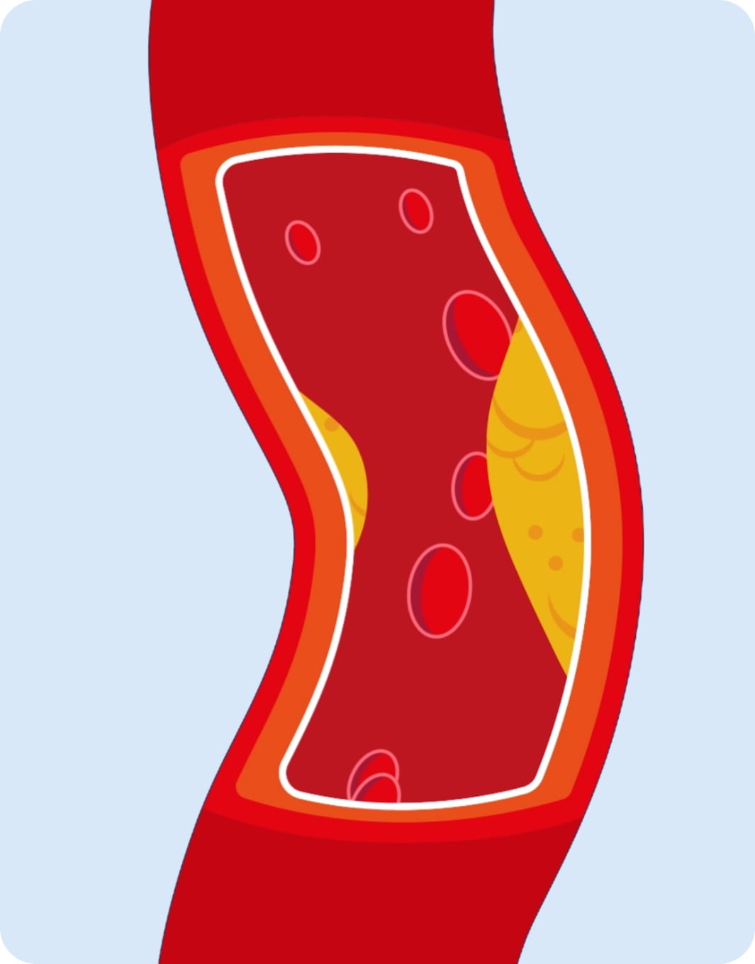 Plaque Building in Artery Wall